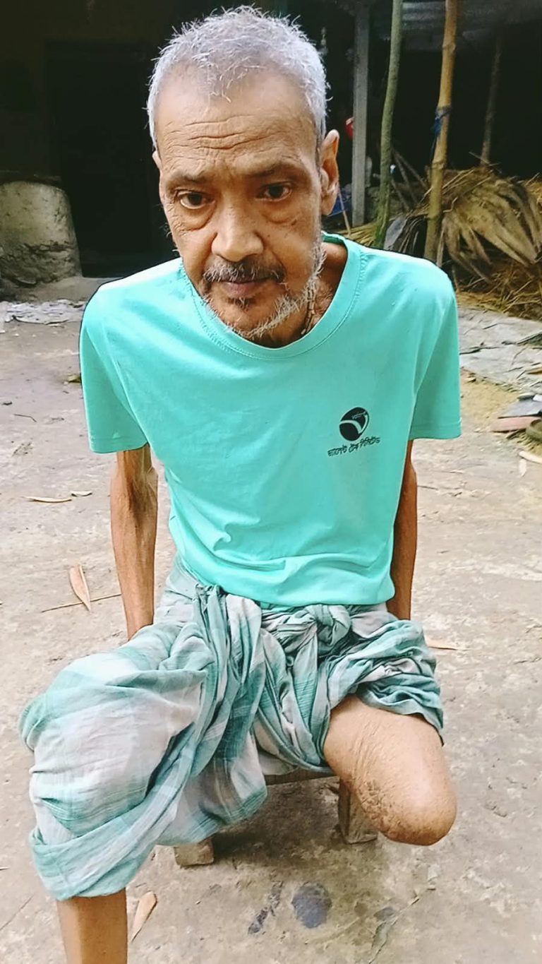এক পা হারিয়ে থমকে গেছে নন্দীগ্রামের কুমার অজিত পালের জীবন, ভাঙা ঘরে অনাহারে কাটছে পরিবার